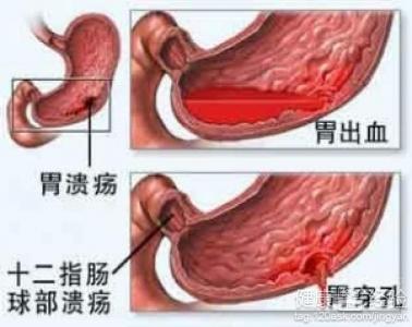 胃潰瘍是如何形成的