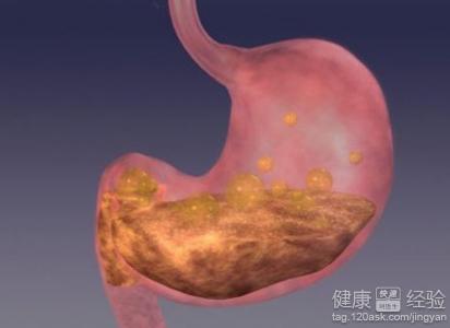 胃潰瘍患者的飲食要注意什麼？
