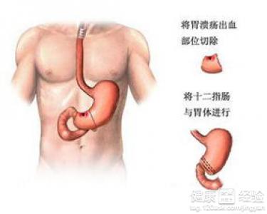 中度萎縮性胃窦炎是怎麼回事