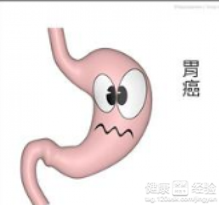 胃窦炎得胃癌早期有什麼症狀