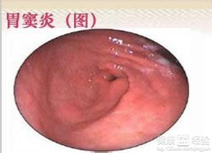 什麼是紅斑性胃窦炎
