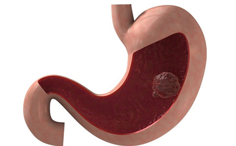 患胃潰瘍吃什麼食物好 胃潰瘍飲食禁忌 胃潰瘍能吃什麼