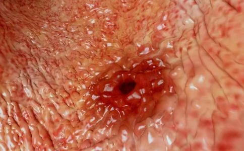 胃潰瘍癌變有什麼征兆 胃潰瘍的症狀有哪些 如何判斷胃潰瘍