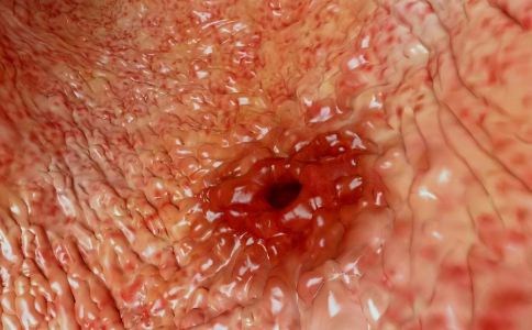 什麼原因引發胃潰瘍 胃潰瘍的治療方法 如何治療胃潰瘍
