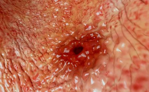 什麼原因導致胃潰瘍 胃潰瘍患者吃什麼好 胃潰瘍怎麼形成的