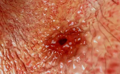 胃潰瘍癌變有什麼征兆 如何預防胃潰瘍癌變 胃潰瘍癌變的症狀