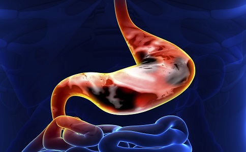 胃潰瘍會癌變嗎 胃潰瘍癌變的信號 胃潰瘍要注意哪些