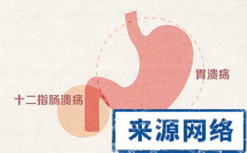 胃潰瘍怎麼診斷 胃潰瘍有哪些症狀 胃潰瘍早期有什麼症狀