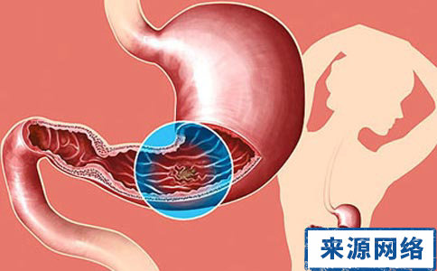 胃潰瘍出血怎麼處理 胃潰瘍出血怎麼治療 胃潰瘍出血怎麼飲食