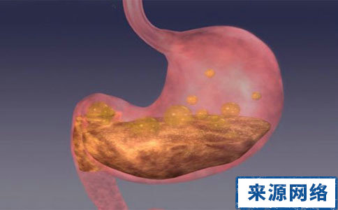 導致胃潰瘍的原因有哪些 哪些原因會導致胃潰瘍 什麼原因會導致胃潰瘍