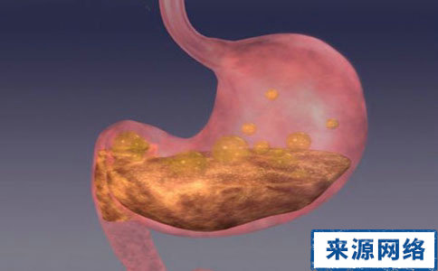 如何治療胃潰瘍 怎麼治療胃潰瘍 胃潰瘍的治療方法