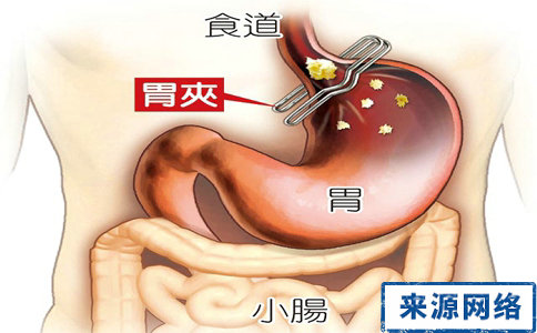 胃潰瘍有哪些症狀 胃潰瘍飲食要注意哪些 哪些人更易患胃潰瘍