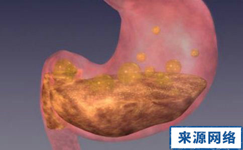 胃潰瘍的治療方法 胃潰瘍怎麼治療 胃潰瘍常見病因