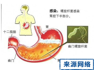 胃潰瘍 胃潰瘍癌變 胃病表現