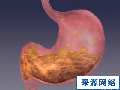 胃潰瘍並發症 胃穿孔 胃出血 幽門梗阻 潰瘍癌變