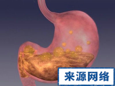 胃潰瘍 胃癌 胃病 消化性潰瘍