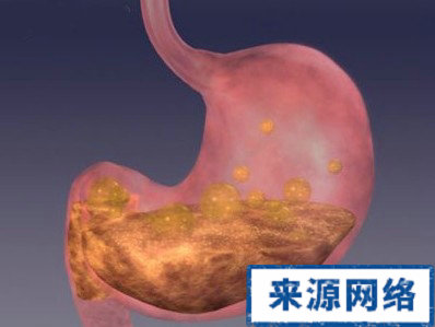 胃潰瘍檢查 胃病 胃潰瘍 幽門螺旋桿菌