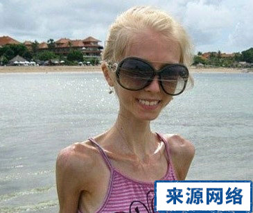 干瘦女性容易胃下垂 為什麼干瘦女性易胃下垂 女性胃下垂