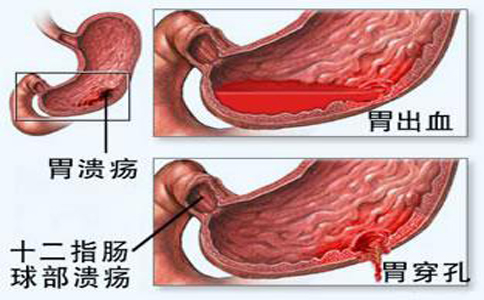 如何預防胃出血 胃出血是怎麼形成的 胃出血的病因有哪些